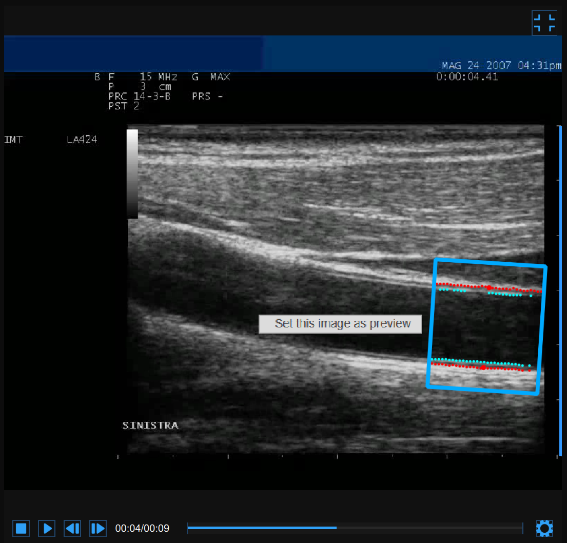 images/download/attachments/34047856/CVS_Carotid_CineloopReview_VideoWindow2.png