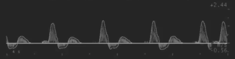 images/download/attachments/34047921/cvs_Ultrasound_DopplerFlow_doppler.png