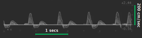 images/download/attachments/61636698/cvs_calibration_doppler_fmd.png