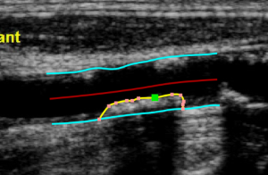 images/download/thumbnails/48496874/CVS_Carotid_SImageAnalysis_PlaqueEdit_EN.png