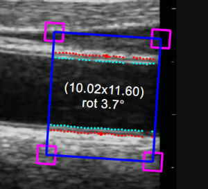 images/download/thumbnails/127893719/CVS_Carotid_CineloopAnalysis_ROI.png
