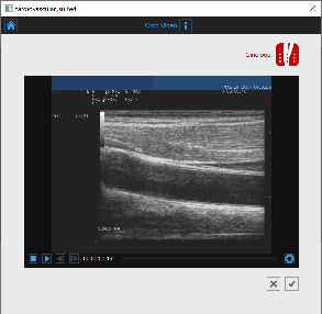 images/download/thumbnails/61636623/CVS_Carotid_NewStudy_CropVideo_EN.PNG