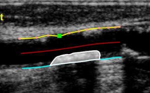 images/download/thumbnails/48496874/CVS_Carotid_SImageAnalysis_BorderEdit_EN.png