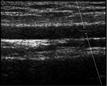 images/download/attachments/381258618/en_Ultrasound_Brachial-version-1-modificationdate-1759328517236-api-v2.png